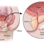 Cáncer de próstata: el tumor maligno de mayor incidencia en hombres