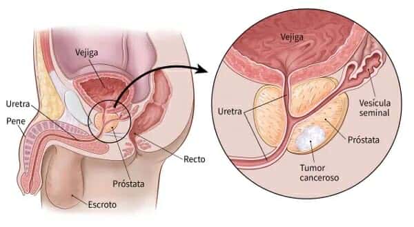 Según el Registro Nacional de Tumores, el cáncer de próstata representa una carga significativa para el sistema de salud del país.